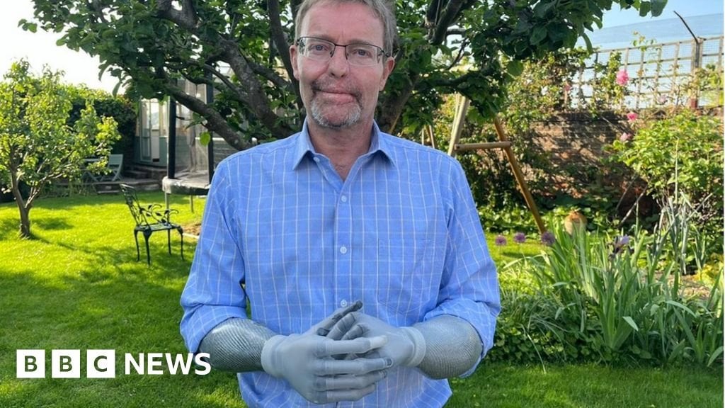 My feet and hands were amputated after sepsis, says MP
