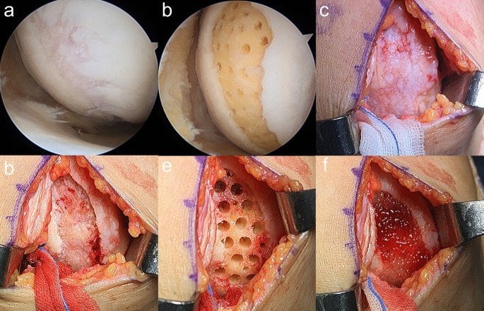 A study out of South Korea shows "mesenchymal stem cells" can regrow cartilage in the knee. Hopefully they can confirm the results in a larger trial.