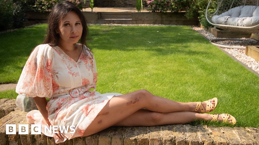 Leg-lengthening: 'I had surgery to get taller but then it went horribly wrong'