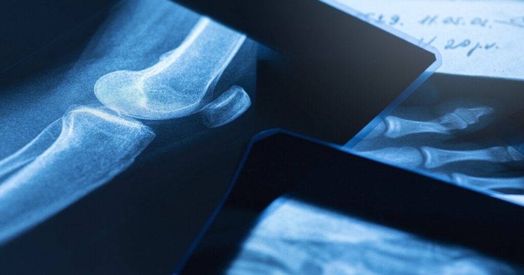 Scientists have demonstrated a new potential treatment for bone cancer | A bioactive glass laced with a toxic metal was able to kill up to 99% of the cancer without harming healthy cells, and could even help regrow healthy bone after.