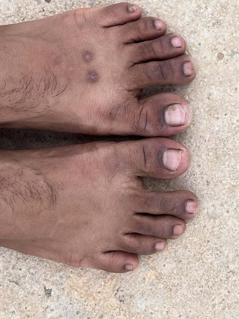 Black toes