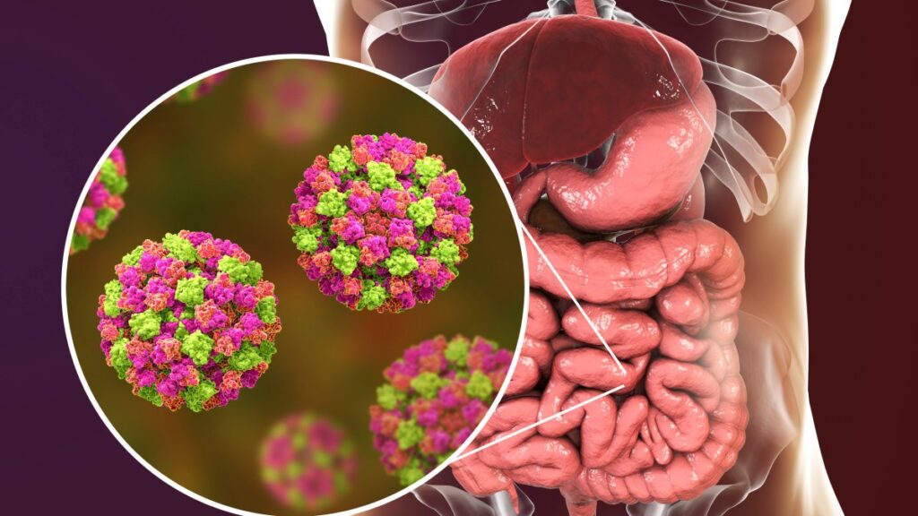 Health leaders raise concerns about winter surge in norovirus – NBC 5 Dallas-Fort Worth