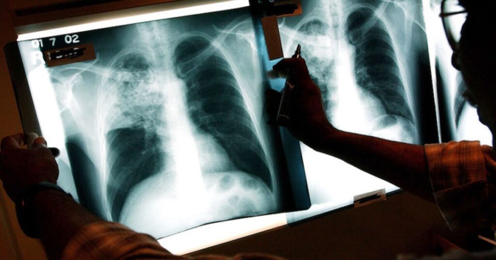Tuberculosis outbreak in KC-area is largest outbreak in US history Tuberculosis outbreak in KC-area is largest outbreak in US history