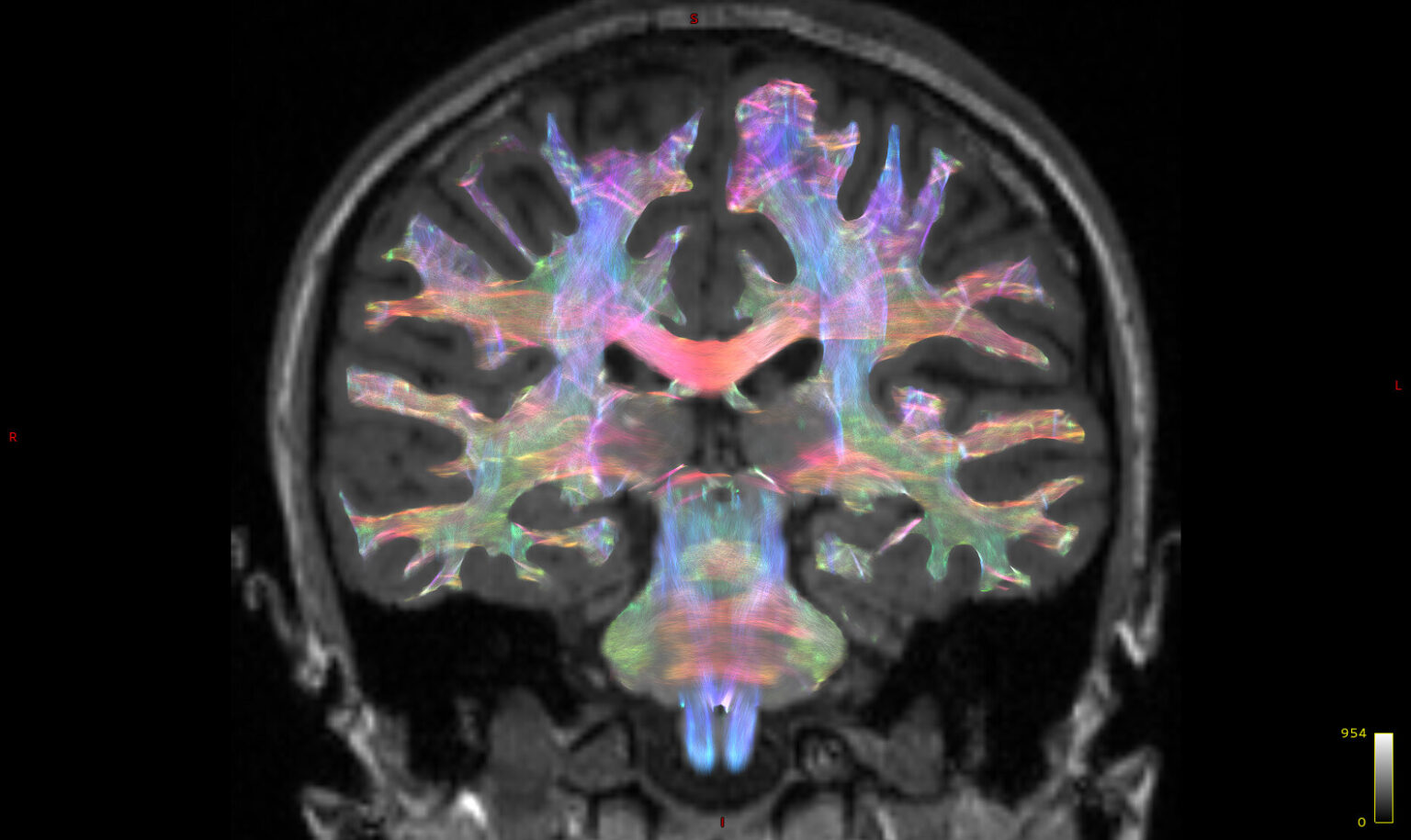 Climate Change, Vaccine Hesitancy And Vector-borne Diseases Are Driving Encephalitis