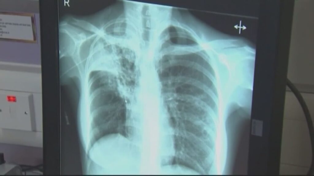 Health department says tuberculosis cases remain low in Kansas City