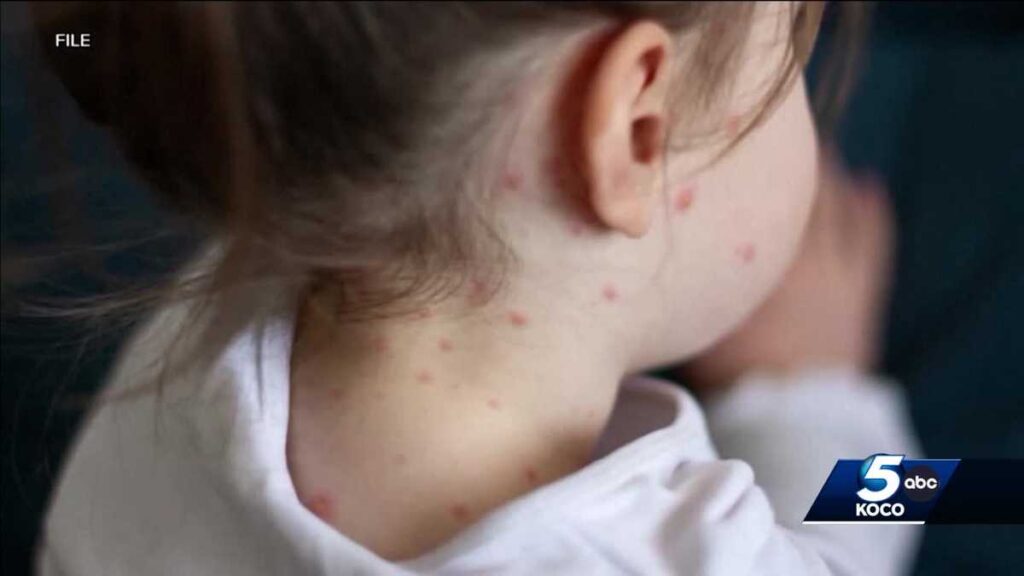 Oklahoma health officials warn of two more possible measles cases