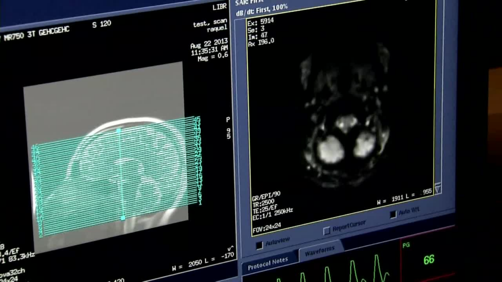 Recovering after a traumatic brain injury