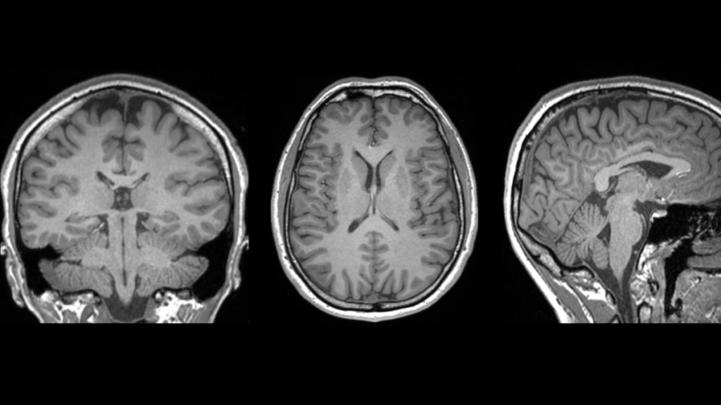 Brain injury breakthrough: New Zealand scientists discover telltale marker after concussion Brain injury breakthrough: New Zealand scientists discover telltale marker after concussion