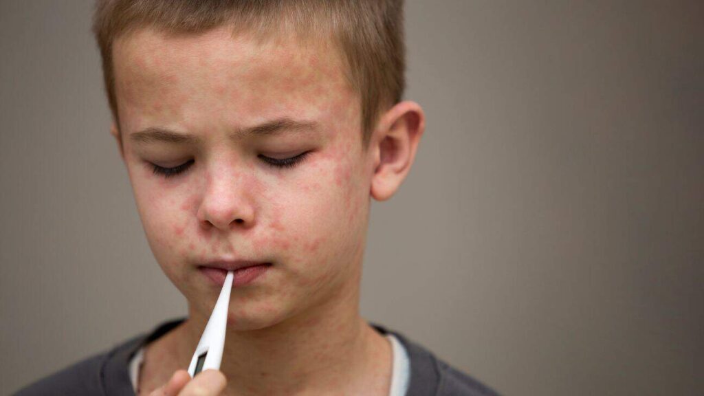 Choctaw Nation Public Health Advisory: Measles Outbreak Monitoring and Prevention Choctaw Nation Public Health Advisory: Measles Outbreak Monitoring and Prevention