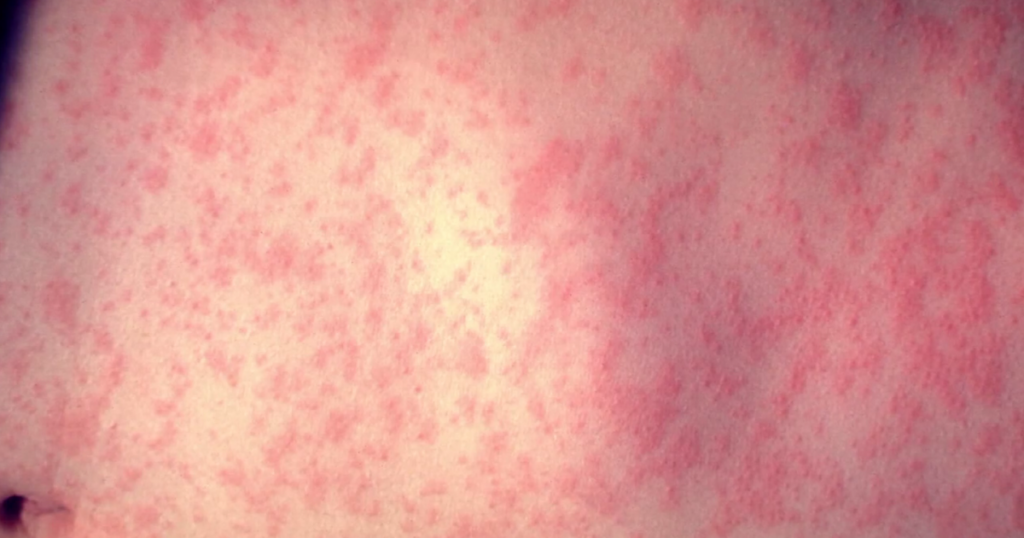 Measles case confirmed on Long Island, health officials say Measles case confirmed on Long Island, health officials say