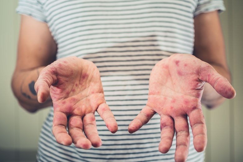 Virginia Department of Health warns of potential measles exposure in Woodbridge, Fredericksburg