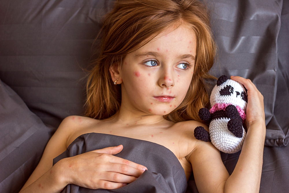 Spain warns of Andalucia measles outbreak « Euro Weekly News