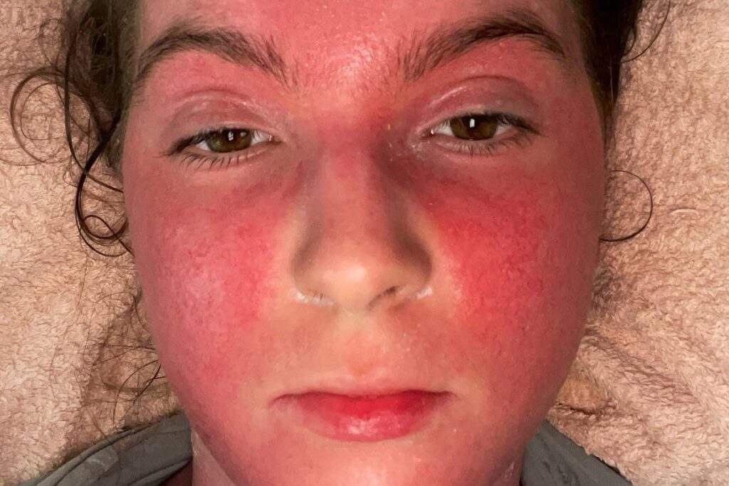 Young woman ‘would do anything to have eczema again’ after steroid withdrawal