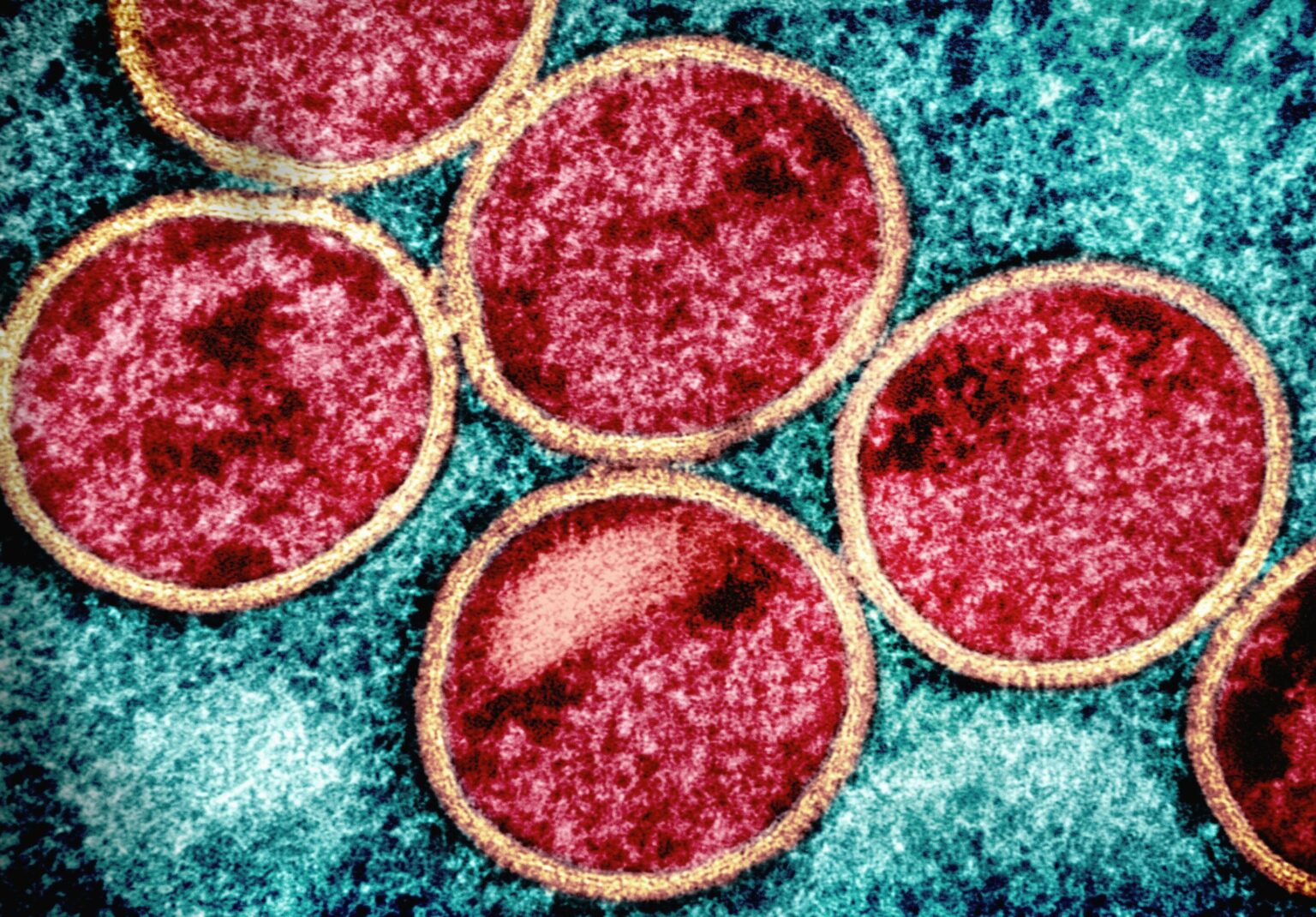 North Macedonia reports first cases of mpox