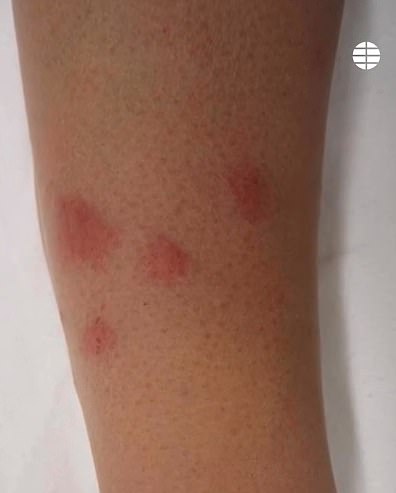 Images show multiple red insect bites on the arms of airport staff