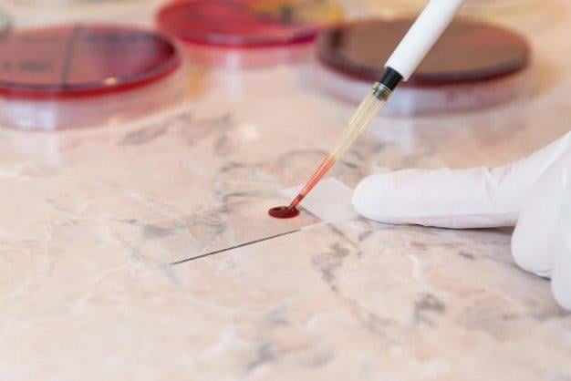 Annual multi-cancer early detection blood tests could spot cancer early and help more people survive cancer. The blood test looks for DNA fragments shed by tumors. Annual blood testing was associated with 49% fewer late-stage cancer diagnoses and 21% fewer deaths within five years.