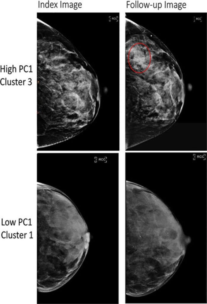 New Research: Texture Patterns Can Help Identify Breast Cancer Risk