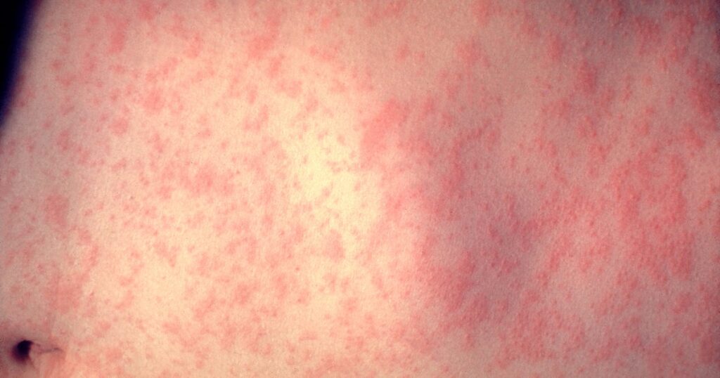 Traveler with measles was at Newark Airport while infectious, health officials say