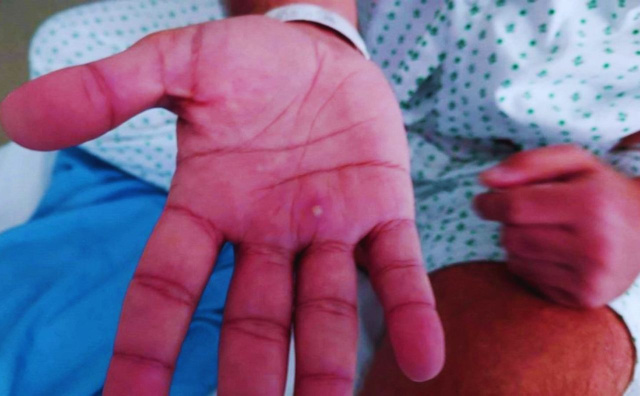 Bulgaria: First Monkeypox Cases Confirmed in North Macedonia: Authorities Respond Swiftly