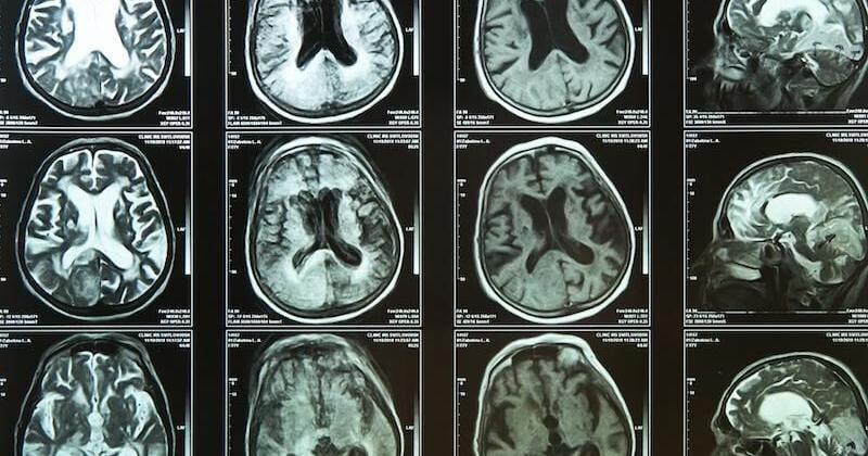 New technology at Tulane maps the Alzheimer's brain | Louisiana Health