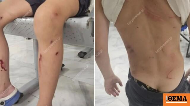 Volos: A 7 -year -old miraculously escaped when he was attacked by stray dogs - almost wasting it, his mother says