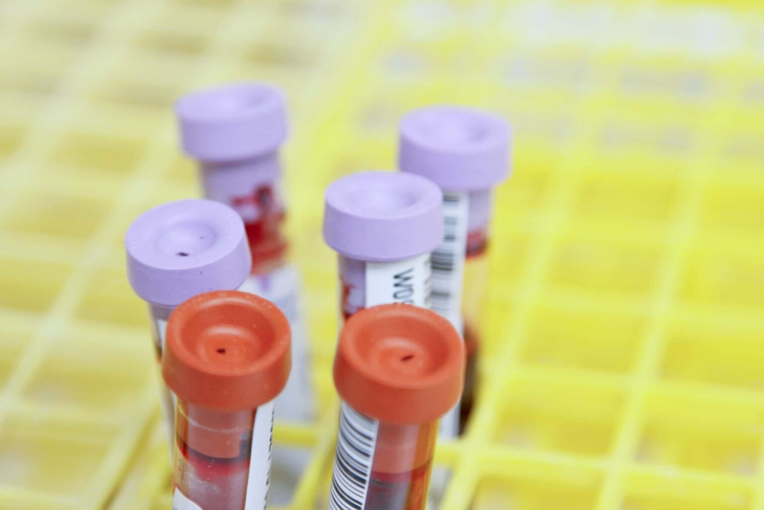 A new blood test using ultra-sensitive DNA sequencing could find cancerous tumors three years before any symptoms | “Three years earlier provides time for intervention. The tumors are likely to be much less advanced and more likely to be curable.”