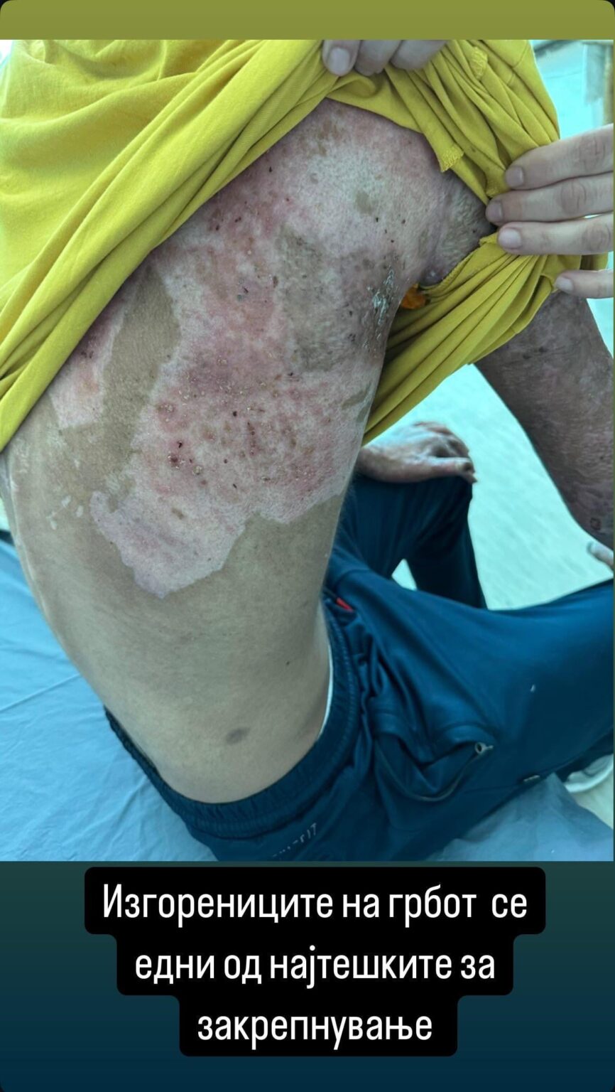 Just a reminder of what burns the children from Kocani ⚠️ Trigger Warning
