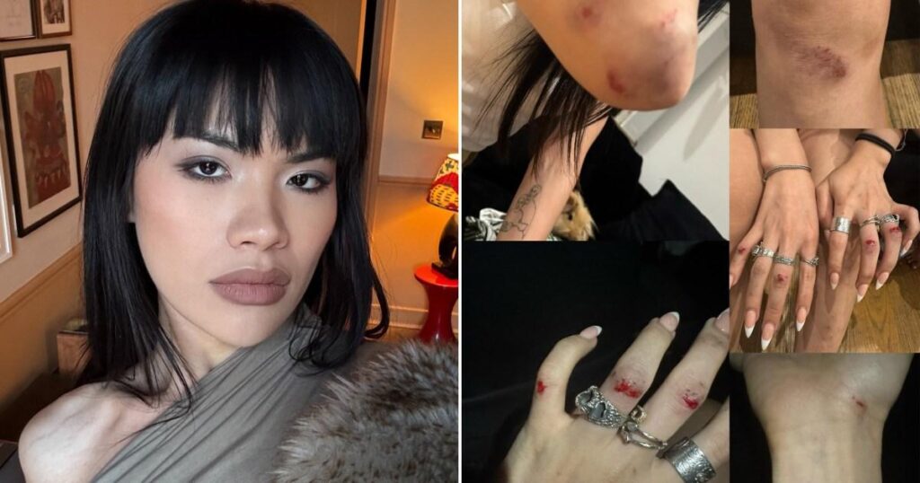 Trans woman ‘covered in blood and bruises’ after transphobic attack in street