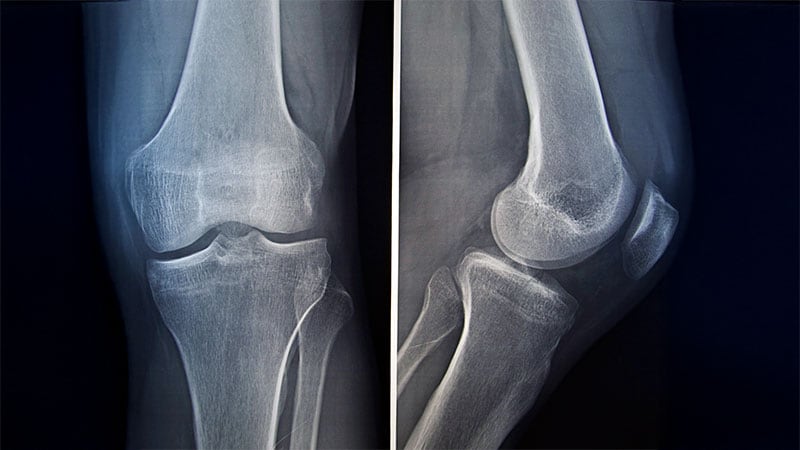 Does AI Aid Rare Bone Fracture Detection in Children?