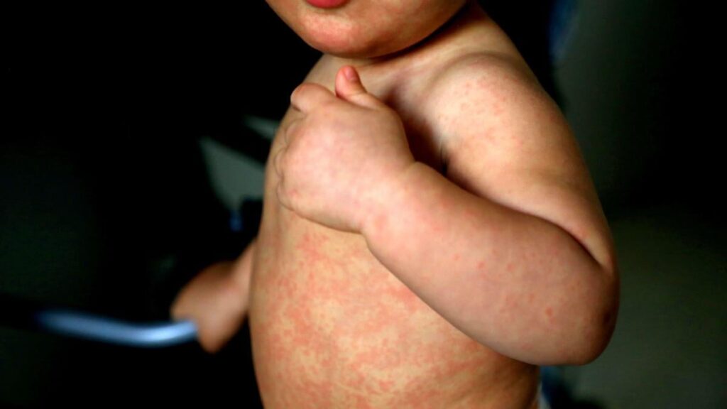 Measles outbreak kills child in Liverpool as vaccination rate plunges