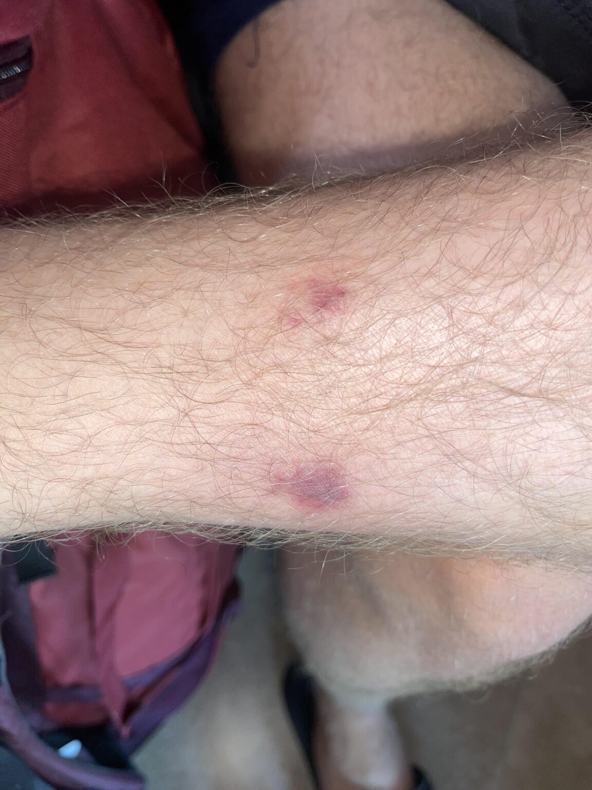 A bug bit me in Kosovo and left these marks - is it okay?