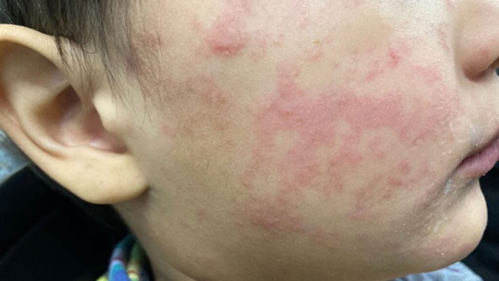 Health officials confirm 6th measles case this year in NJ