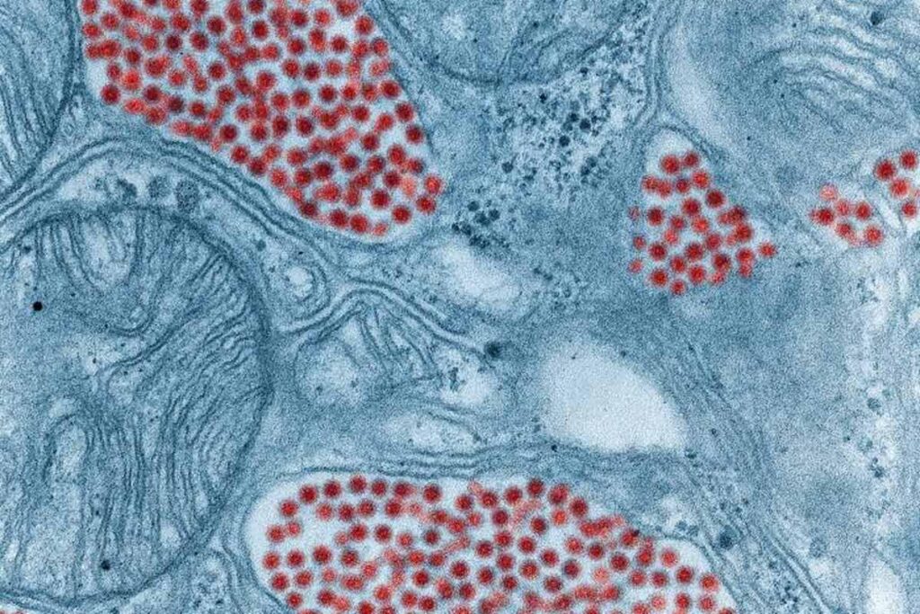 A rare but deadly brain infection is gaining ground in North America as climate change alters mosquito habitats