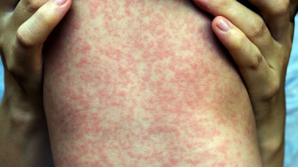 Health officials confirm first measles case in Grand County