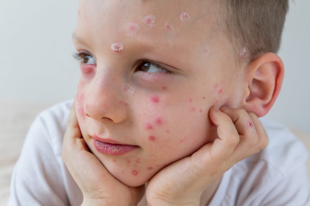 Bulgaria expands immunisation scheme with free chickenpox vaccines Bulgaria expands immunisation scheme with free chickenpox vaccines