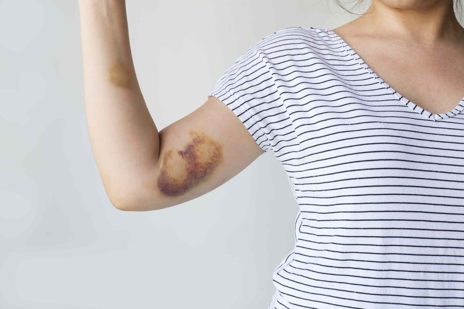 What To Know About Hemophilia, a Rare Blood Disorder