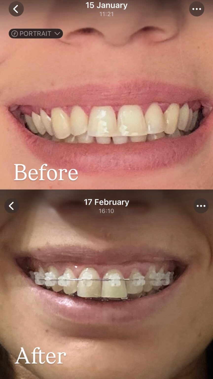 ⚠️ The best experience in my life with orthodontic treatment!