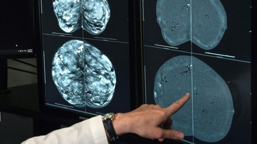 No, Switzerland didn't ban mammograms over radiation risks, false positives