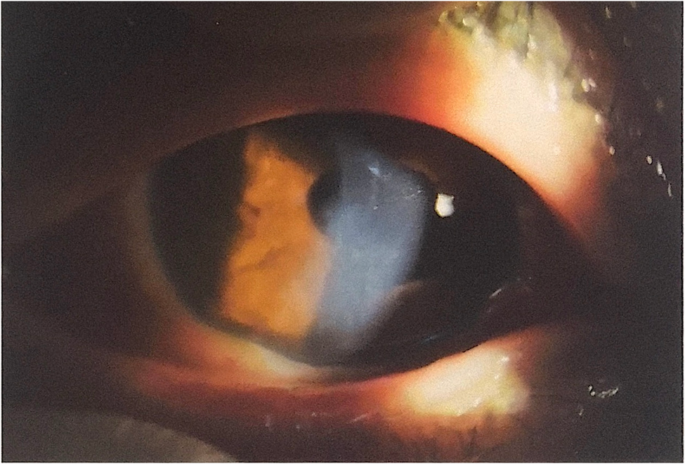 The ocular frostbite involving cornea caused by low-temperature environment | BMC Ophthalmology