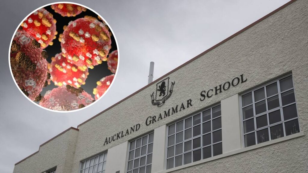 Health NZ confirms measles case at Auckland Grammar, contact tracing under way