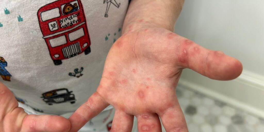 Hand, foot and mouth disease spreading rapidly in this state, officials say
