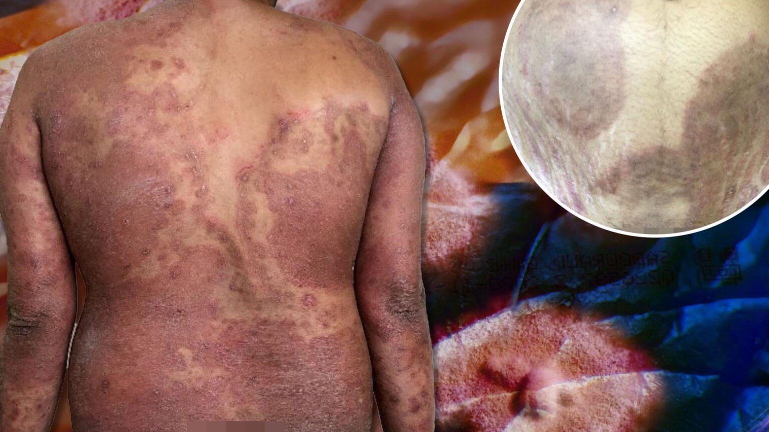 'Avoid skin-to-skin contact,' Brits warned - as 'super fungus' that attacks groin and bum 'spreads at pace'