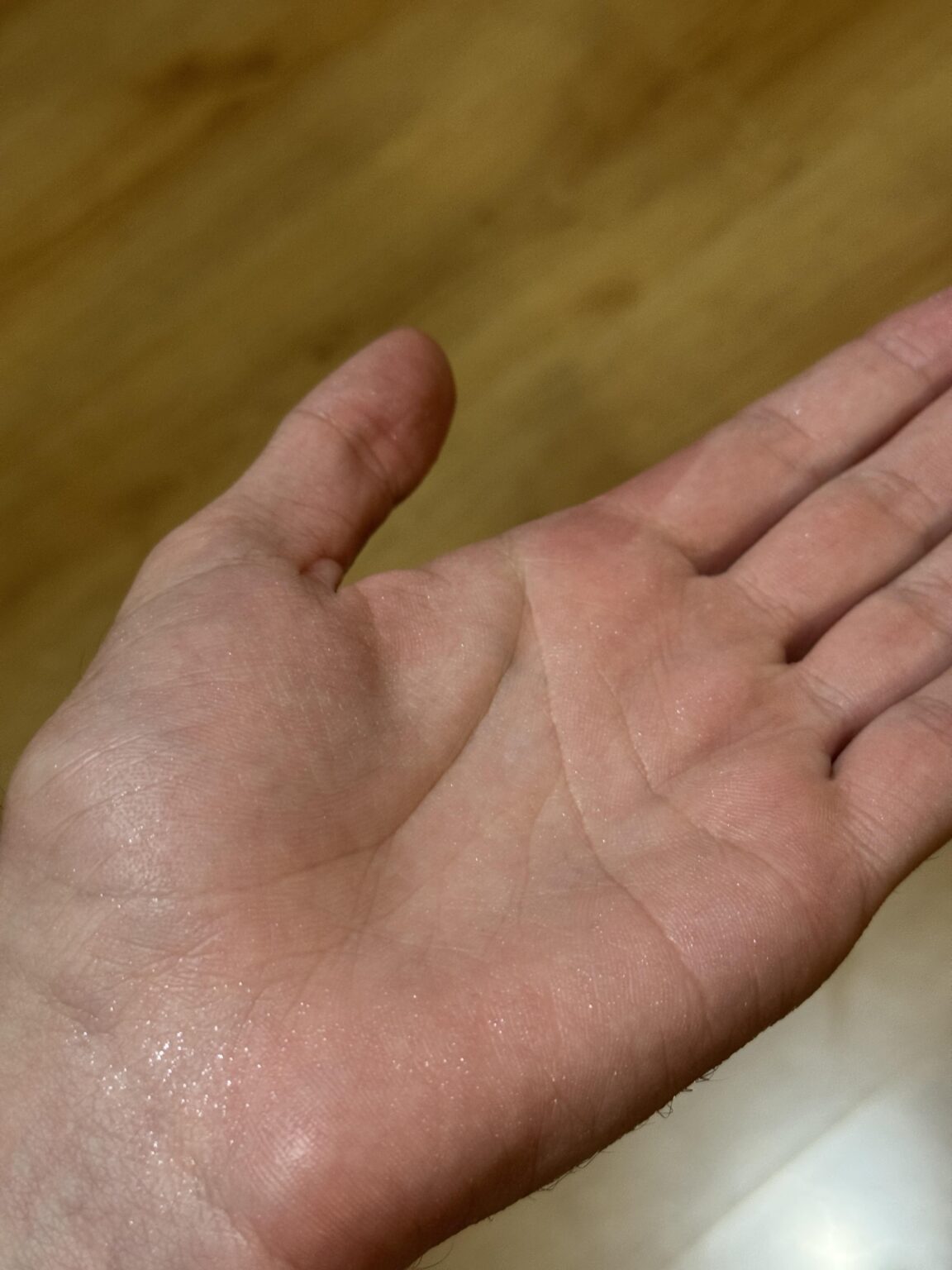 Hyperhidrosis (excessive sweating)