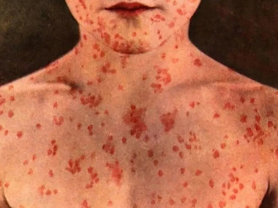 Measles symptoms, which typically appear seven to 21 days after exposure and include high fever, runny nose and cough, red, watery eyes and a distinctive rash that begins on the face and spreads to the rest of the body. Stock Photo