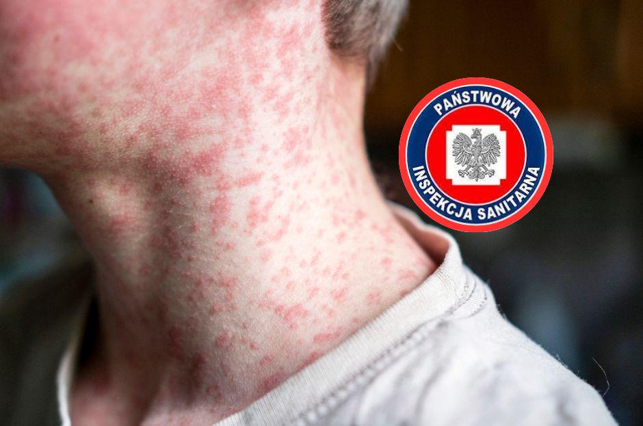 11 cases of measles have already been confirmed in Podkarpacie. The Sanitary and Epidemiological Station is expanding its investigation