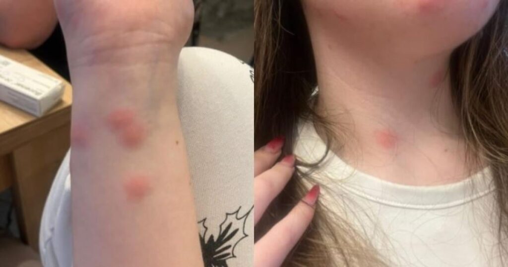 A young woman arrived at the hospital after being bitten by bedbugs on a CFR train