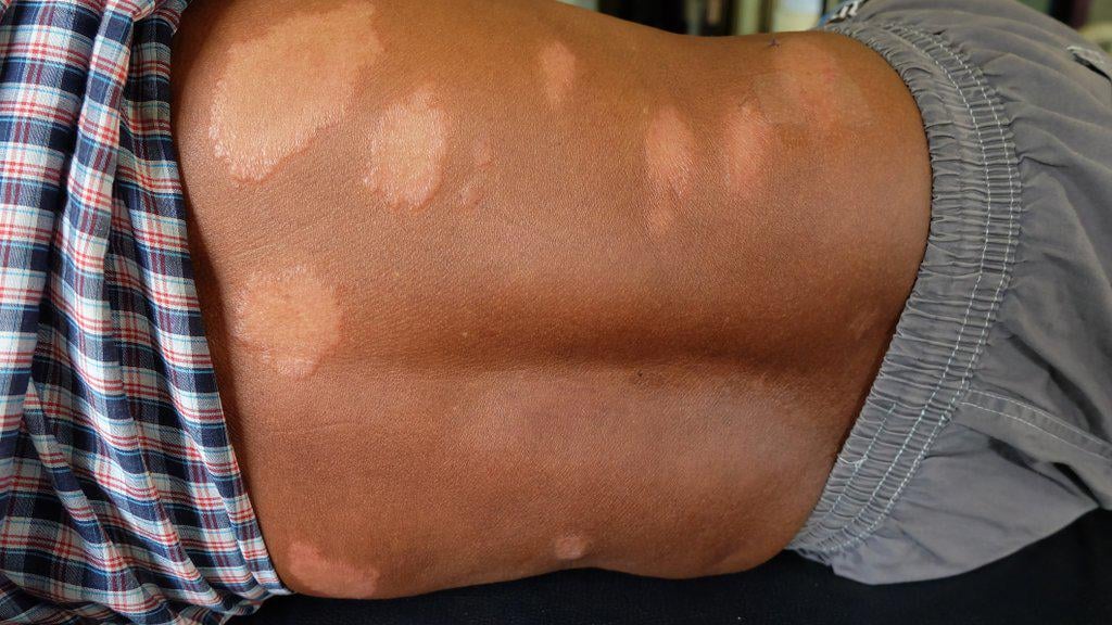 First case of leprosy confirmed in Croatia