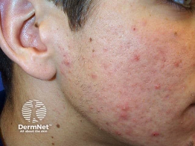 Dermatologic Effects of Energy and High Protein Drinks