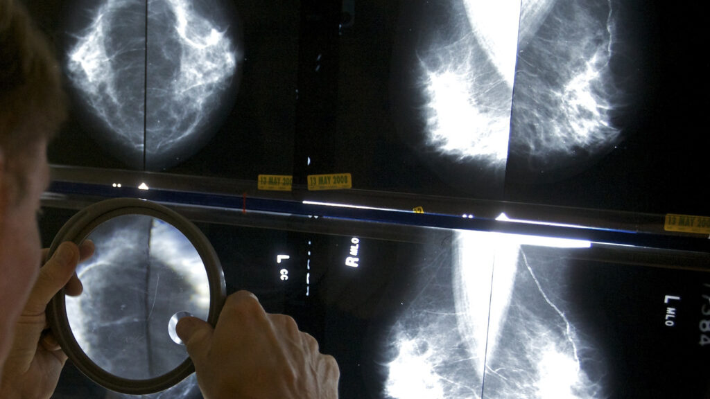 AI firms believe mammograms can spot multiple health risks