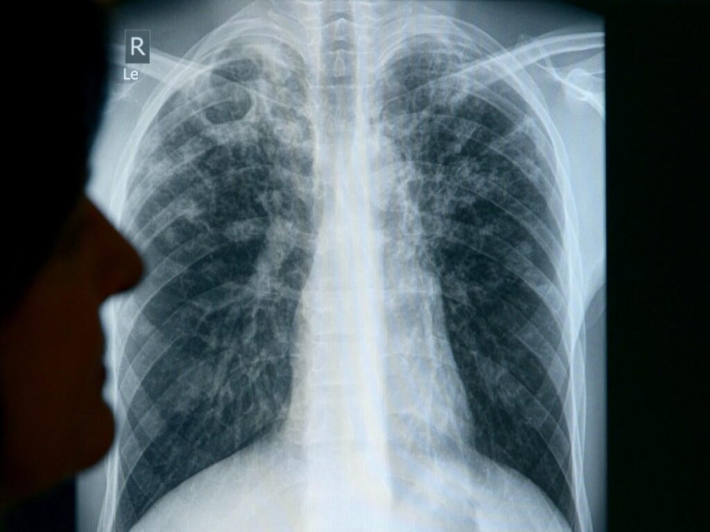 Tuberculosis cases on the rise in Switzerland